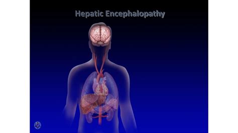 rjvcc he|Hepatic Encephalopathy .